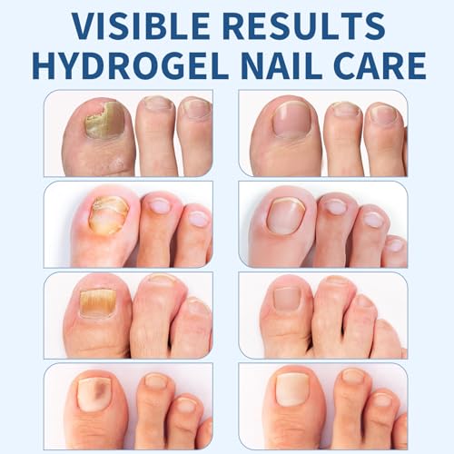Nail Repair Patches - 50 Pcs Overnight Moisturizing Care for Damaged, Discolored, Brittle Nails | Healthy Renewal Solution