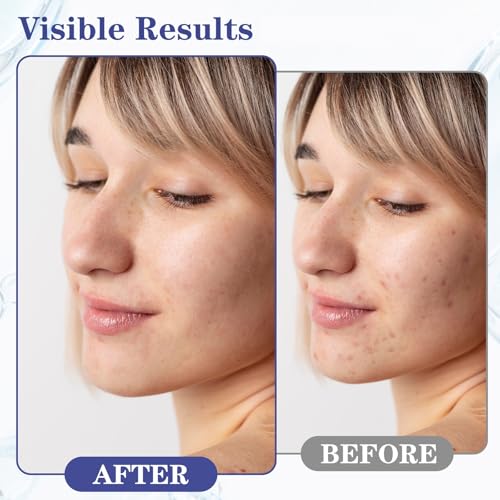 SINPIN 2% Salicylic Acid Acne Control Gel for Face & Body, 1.7 fl oz