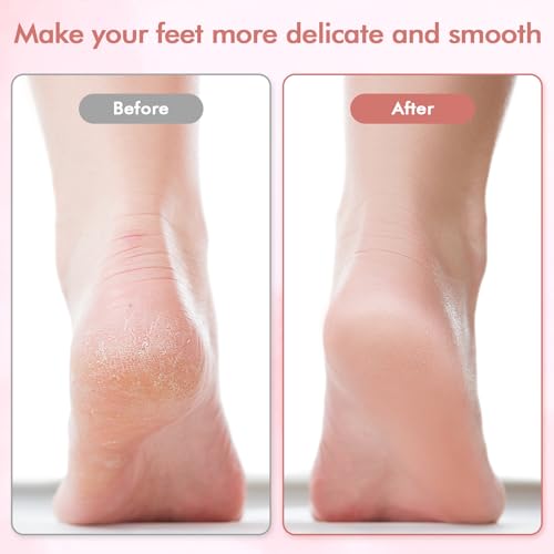 Electric Foot File & Callus Remover - Rechargeable Pedicure Tool