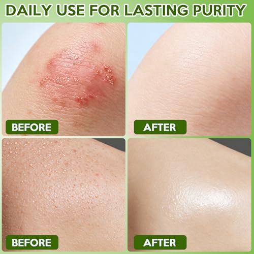 Urrznp Tea Tree Oil Antifungal Soap Bar - Natural Body Wash for Skin Relief