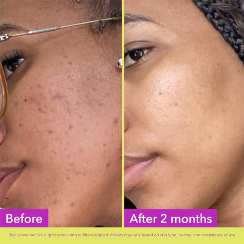 Good Molecules 10% Azelaic Acid Treatment for Even Skin Tone