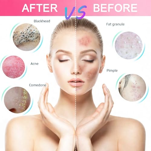 Professional 60PCS Stainless Steel Pimple Popper Tool Kit