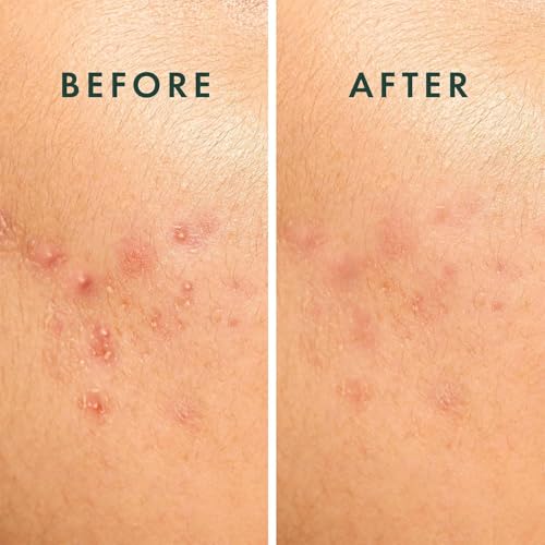 Rael Miracle Spot Control Hydrocolloid Pimple Patches - 10 Ct