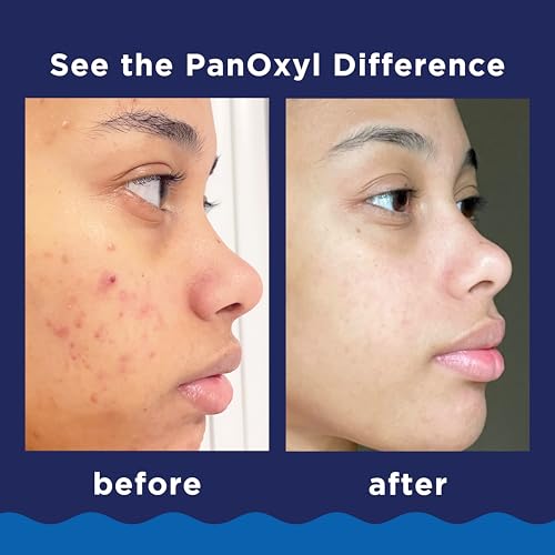 PanOxyl Acne Foaming Wash - 10% Benzoyl Peroxide, 3 oz (Pack of 2)