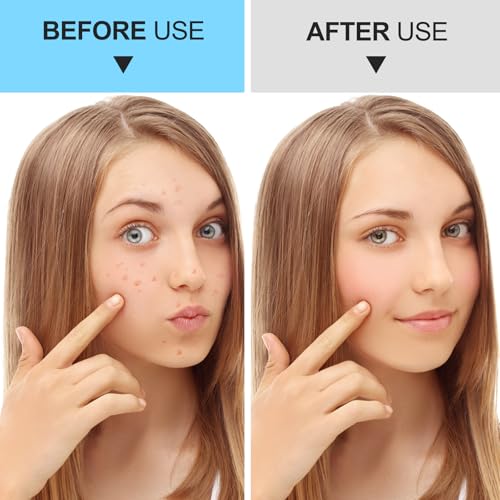 5-Piece Blackhead Remover Tool Kit - Professional Stainless Steel