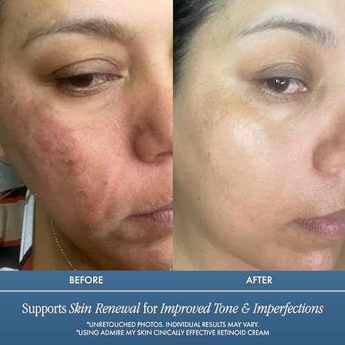 Admire My Skin Retinoid Cream for Face - Anti-Aging Moisturizer