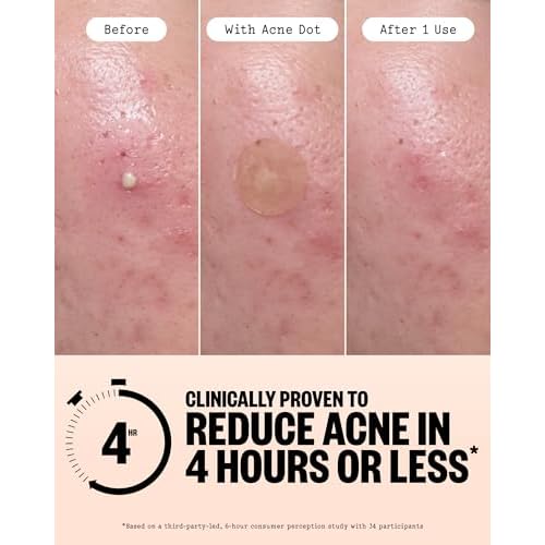 PEACE OUT Acne Day & Night Duo, Invisible Hydrocolloid Pimple Patches for Daytime + Healing Overnight Acne Dots, Clear Blemishes Fast with 2% Salicylic Acid (20 count)