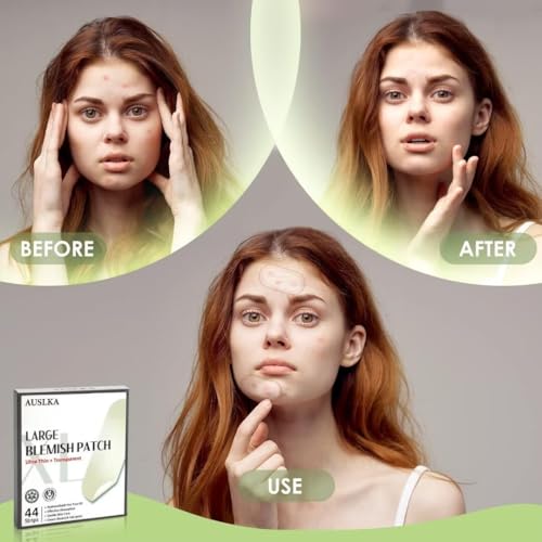 Large Hydrocolloid Blemish Patches - 44 Strips for Acne Care