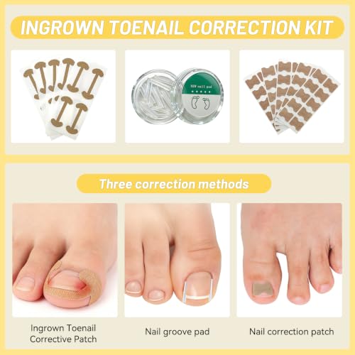 Ingrown Toenail Treatment Kit - Painless Home Care Set