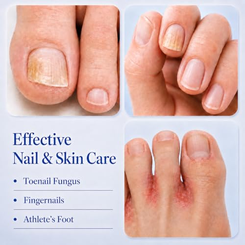 Toenail Fungus Treatment Pen: Extra Strength 25% Undecylenic Acid & Tea Tree Oil - Fungal Nail Treatment for Thick Yellow Brittle Toenails and Fingernails, 4 PCS
