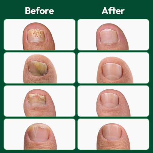 VERDORA Extra Strength Nail Patches with Tea Tree Oil - 16 Pcs