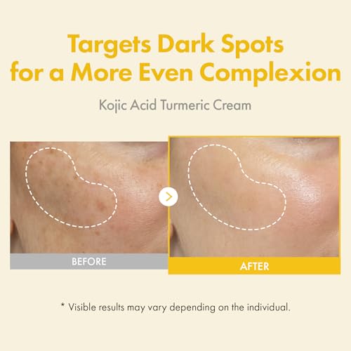 TOSOWOONG Kojic Acid Turmeric Cream for Dark Spots & Even Tone - 50ml