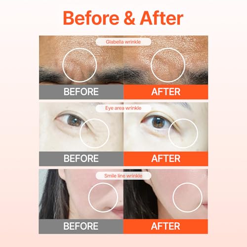 Acropass Microcone Wrinkle Patches - Anti-Aging Treatment for Deep Wrinkles (4 Count)