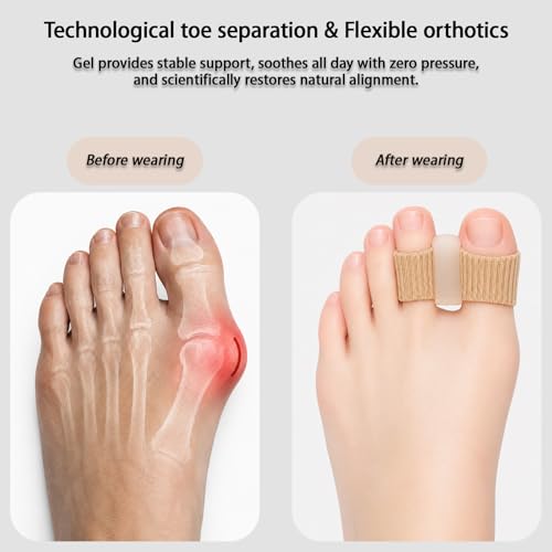 NUGRXIS Silicone Toe Spacers & Bunion Correctors, 4-Pack Gel Separators