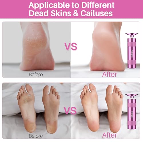 SENROU Electric Foot Callus Remover - 2-in-1 Filer & Nail Filer, 1 Count (Pink)