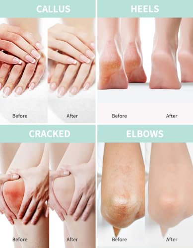 Grocerism 20% Urea Foot Cream with 2% Salicylic Acid – Daily Moisturizer for Dry Skin