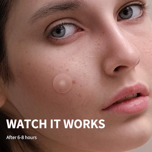 Daolyo 300 Pimple Patches for Face - 4 Sizes Hydrocolloid Acne Spot Treatment
