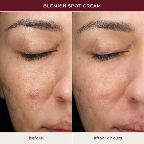 ITK Salicylic Acid Acne Spot Treatment - Fast Blemish Relief 0.5oz
