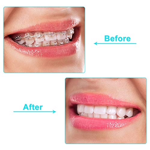 BBTO 60 Pcs Silicone Aligner Tray Seaters for Orthodontic Clear Aligners