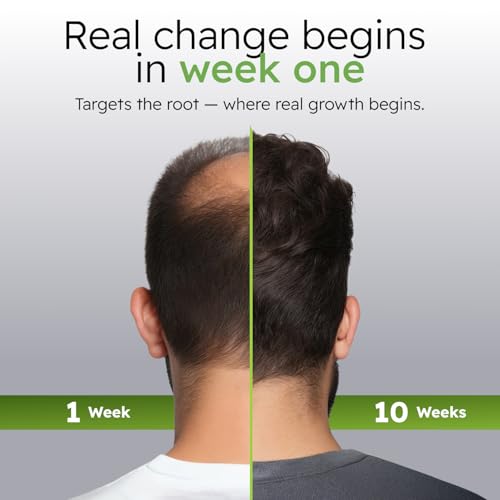 AlphaInfuse¢â Scalp Nourishing Serum for Men ? Ginseng & Eclipta Botanical Blend for Fuller-Looking, Thicker-Looking Hair and Healthy Scalp ? 32ml ? 2 Month Supply