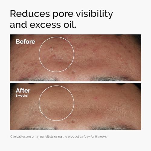 The Ordinary Niacinamide 10% + Zinc 1% Serum (2-Pack) - Blemish Control & Hydration