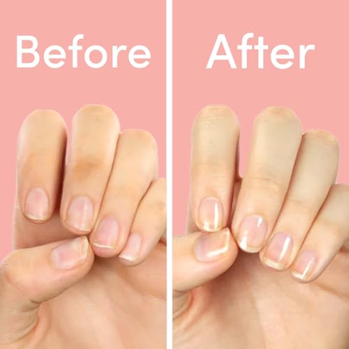 ella+mila Nail Strengthener and Growth Treatment - First Aid Kiss Nail Hardener for Damaged Brittle Thin Nails - Strengthening Polish with Vitamin E - Vegan (0.45 fl oz)