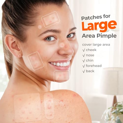 TKTK Large Pimple Patches - XL Acne Stickers, 306ct in 7 Sizes
