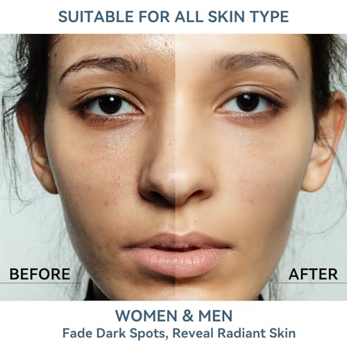 Dark Spot Remover Serum for Face & Body with 360° Roller Ball