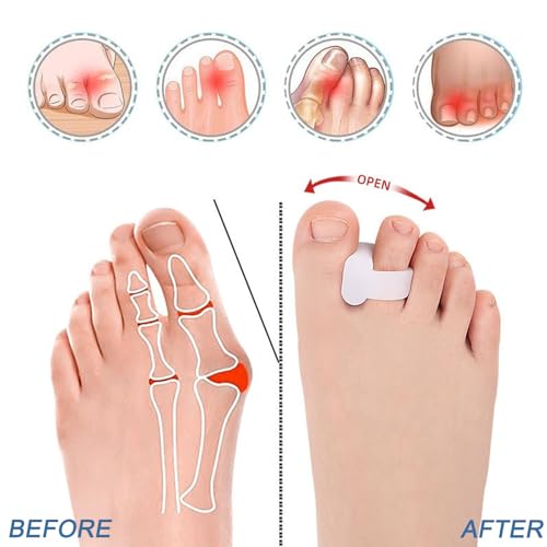 Sanpoob 10Pcs Gel Toe Spacers - Blue | Bunion Relief, Overlapping Toes Corrector
