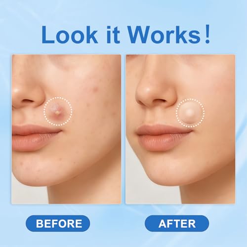 Amouy Acne Pimple Patch- 2 Sizes 612 Dots Thin & Thick Hydrocolloid