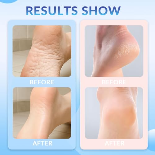 XICOFISS Pink & Blue Foot Crack Prevention Stick Set - Moisturizing & Repair Foot Balm