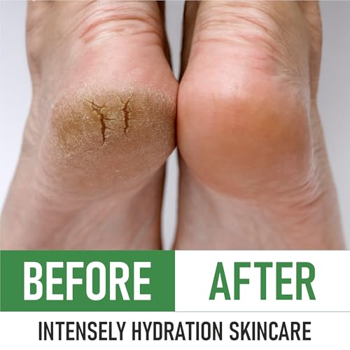 PurOrganica Urea Cream 40% ? Made in USA, Maximum Strength Foot Cream for Dry, Cracked Heels, Corns, Calluses & Rough Feet, Exfoliating Moisturizer