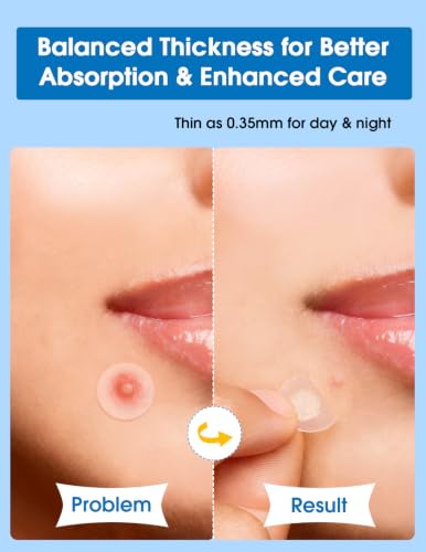 Hydrocolloid Acne Patches - 560 Count, 6 Sizes with Tea Tree & CICA
