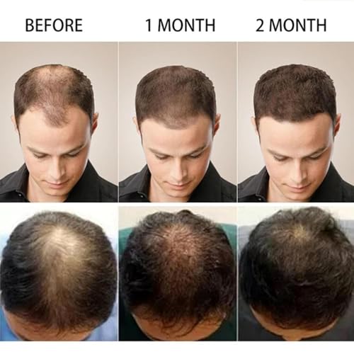 MQN 5% Minoxidil Hair Growth Scalp Cream with Biotin for Hair Loss