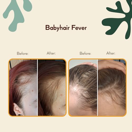 HairTry Babyhair Fever Scalp Serum for Thinning Hair - 3.38 Fl. Oz