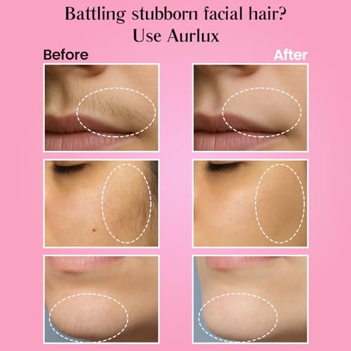 Trilogy Kit for PCOS Facial Hair Removal for Women - Clinical Grade Hair Remover for Women Chin Upper Lip - 3 Step System Lasts 3-4 Weeks - Soothing Gel with Aloe Vera & Vitamin E