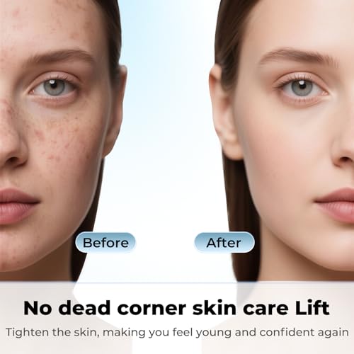 MIRVIAST Dual-Ended Blackhead Remover Tool for Deep Cleansing