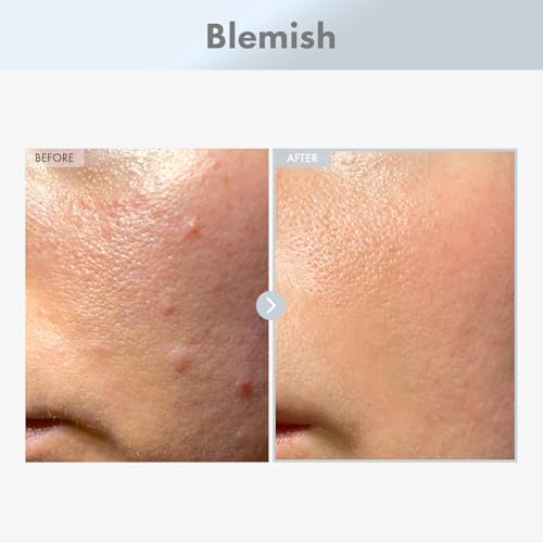 TOSOWOONG Niacinamide 15% Face Serum for Pore Minimizing & Dark Spots, 30ml