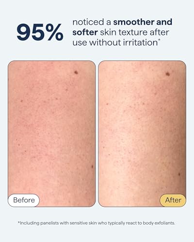 KP Exfoliating Body Scrub with Fine Sugar - Keratosis Pilaris Treatment, 6.8 fl oz