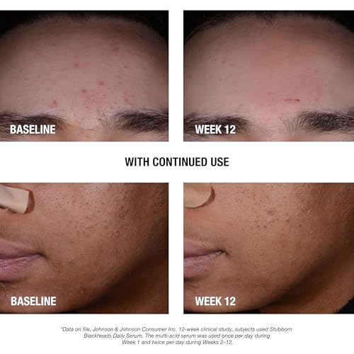 Neutrogena Stubborn Blackheads Daily Acne Serum, 1 fl oz
