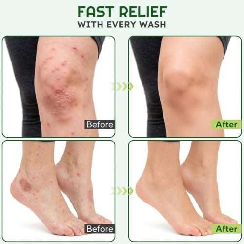 Antifungal & Antibacterial Tea Tree Oil Soap Bar - 2 Pack for Skin Care