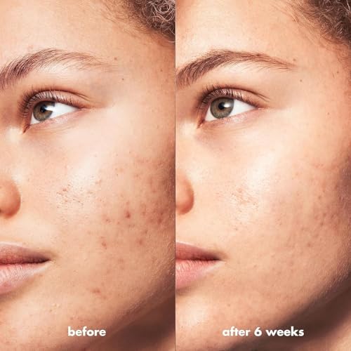 e.l.f. SKIN Blemish Breakthrough Triple-Acid Resurfacing Night Serum 0.14 Fl Oz