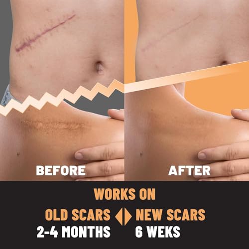 TOLEVITA Silicone Scar Patches – 5 Sheets for Scar & Acne Care