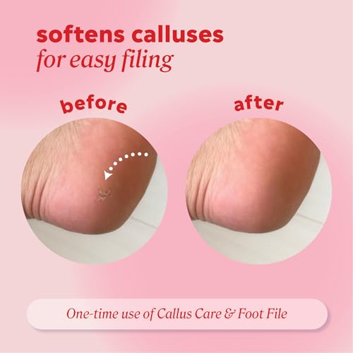Onyx Professional Callus Remover Gel - Fast Acting 4 fl oz