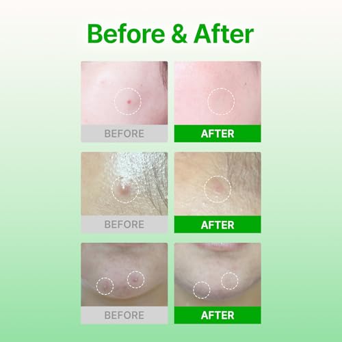 Acropass Trouble Care Microcone Acne Patch 6 Count Spot Treatment with Niacinamide