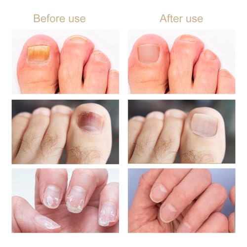 Toenail Repair Patches - 30 Hydrogel Nail Treatment for Damage