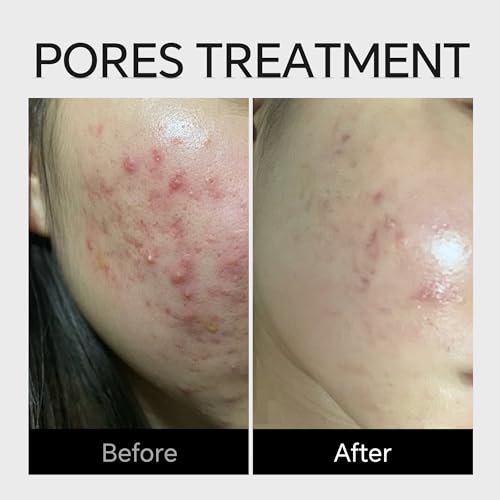 10% Azelaic Acid Serum for Acne, Rosacea & Redness Relief - 1.59oz