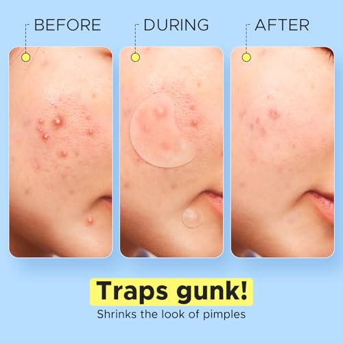 LitBear Large Pimple Patches - XL Hydrocolloid Acne Stickers (228 Count)