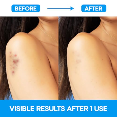 EZACNE XXL Body Pimple Patches - Medical-Grade Hydrocolloid for Back & Chest