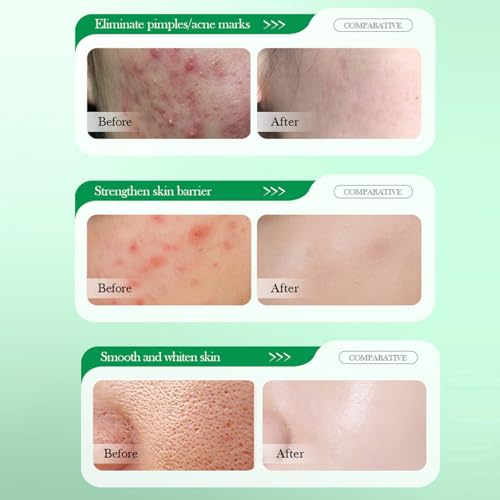 Grospe Salicylic Acid Repair Cream 1.78 Fl Oz - Acne & Pore Shrinkage Moisturizer for Oily Skin (Pack of 2)